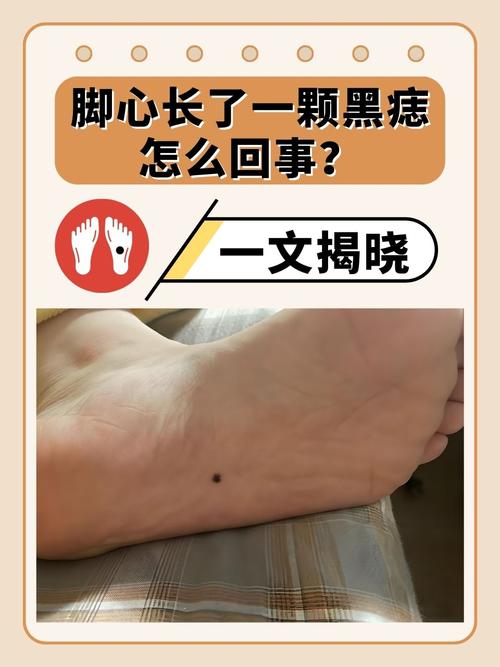 男人腳心有痣寓意前途無量是真的嗎？