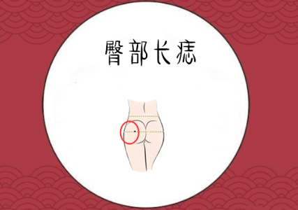 女人左邊臀部長痣好不好，代表什么意思？