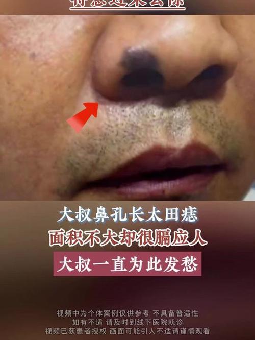 臉上有胎記的男人面相 鼻頭胎記賺錢強