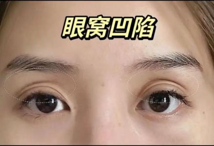 眼睛下陷的人洞察力就強嗎