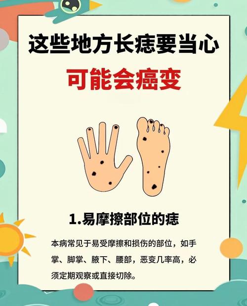 這四處痣會給你帶來大麻煩！需注意！