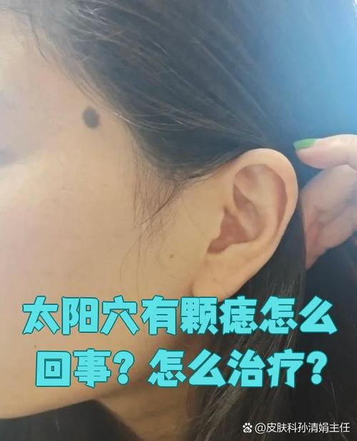 千年積德痣 眼尾有痣 太陽穴有痣