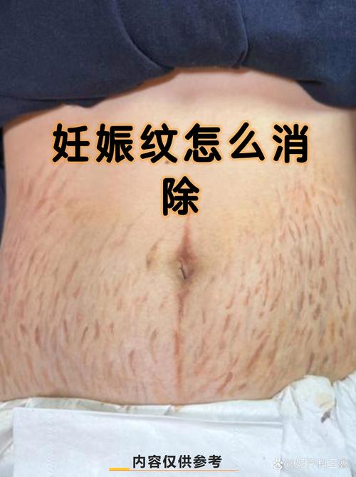妊娠線會(huì)自己消失嗎