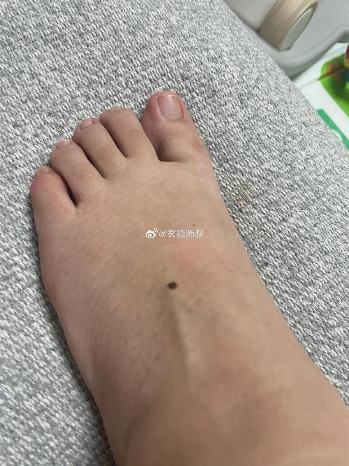 男人的腳背腳面上長痣好不好 腳背長有痣代表什么