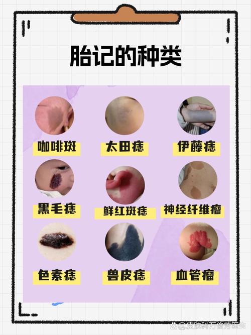 寶寶額頭上有胎記說明什么