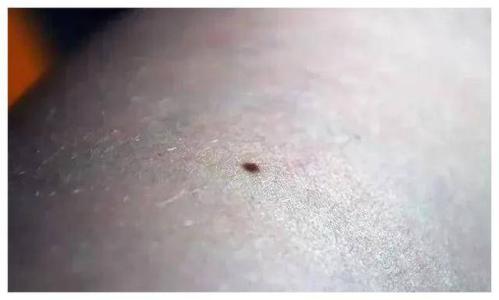 男性生殖器上長黑痣是怎么回事 睪丸有痣的男人命運