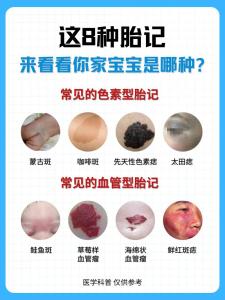 胎記是怎樣形成的