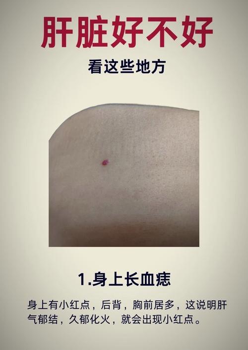 痣相身上有很多紅痣