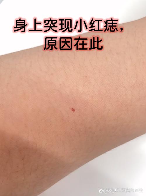 手臂上朱砂痣的含義 事業(yè)運勢發(fā)展較好