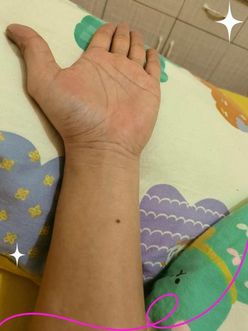 左手朱砂痣位置 左邊胳膊事業(yè)旺盛