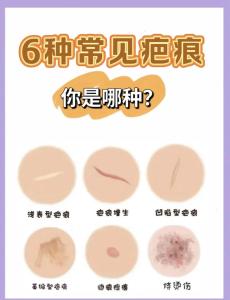 生男生女 臉上有疤容易生男孩還是女孩