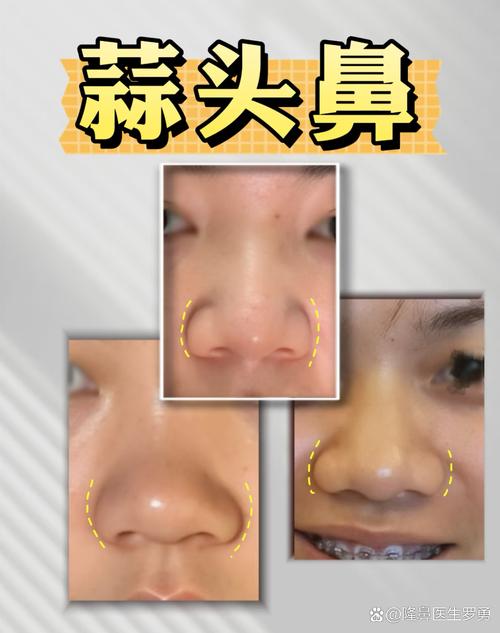 蒜頭鼻子有什么影響