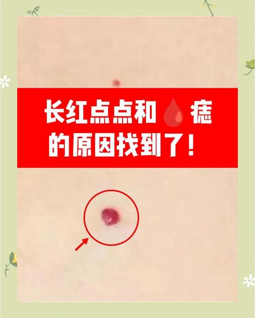 皮膚上有紅色的血痣是怎么回事 身上長血痣是怎么回事