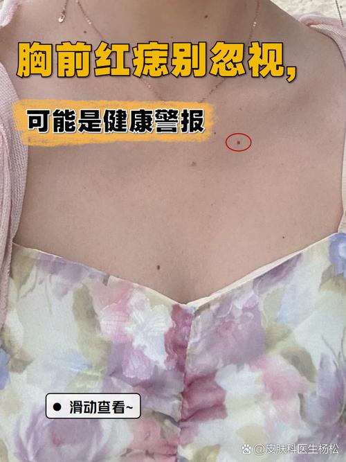 女人女生胸口上有痣代表什么 女人胸部上有長紅痣好不好