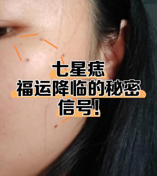 臉上有七星痣代表什么 臉上有護體北斗七星痣的人好嗎好處有什么