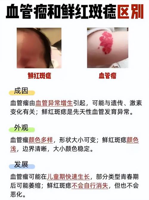 什么是紅胎記