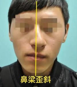 歪面相 鼻子歪了是什么預兆