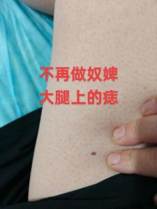 大腿上有痣的女人命好嗎 女人大腿根部有痣代表什么