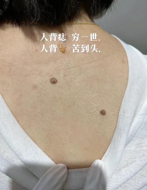 男人后背長痣：可能受到慢性疾病的折磨！