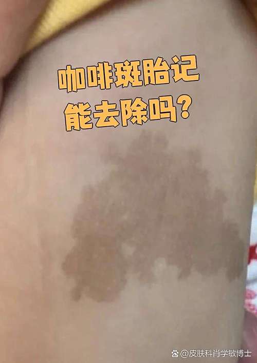 什么顏色的胎記最好 事業(yè)蒸蒸日上自我提升能力強(qiáng)