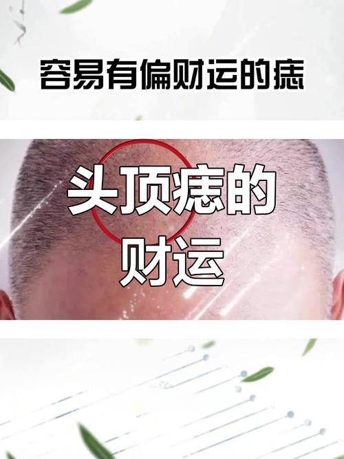 頭頂長痣的男人命運 男人頭頂有痣好嗎