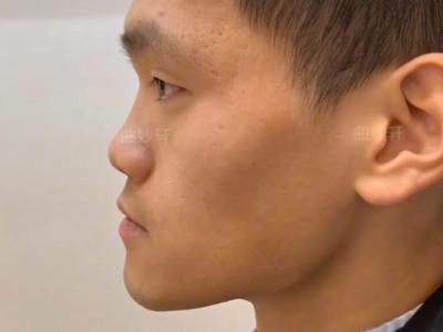 鼻子塌陷的男人容易一事無成嗎