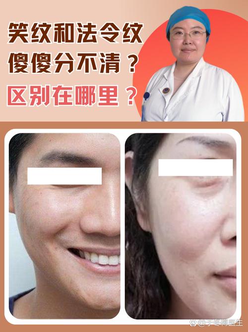 笑紋和法令紋的區別圖解