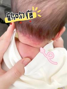帶胎記的孩子是來報恩的 鎖骨兩端有胎記是來報恩的