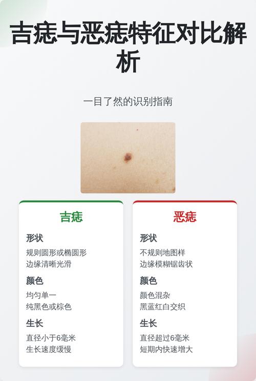 好痣和惡痣的區別