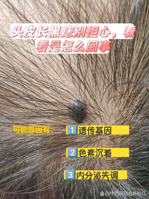 頭頂上有痣的女人好嗎 頭皮上長黑痣是什么原因