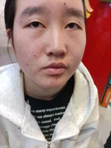 嘴上人中的痣可以點掉嗎 人中有痣可以去掉嗎
