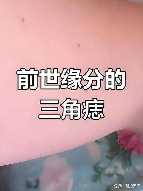 三痣相連的人容易成瘋魔嗎