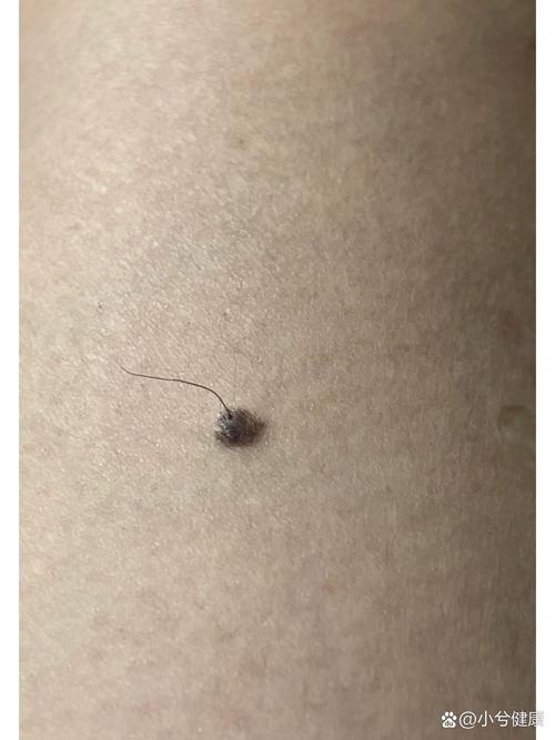 為什么痣上會(huì)長毛