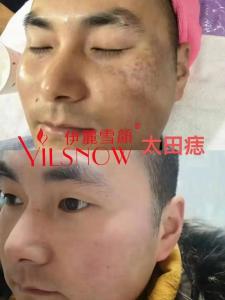 去掉面部太田痣