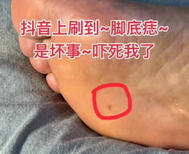 腳底有痣好嗎