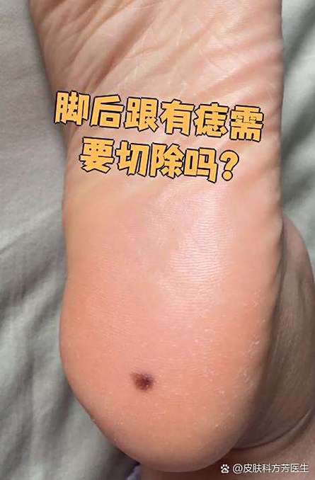 真正有錢的女人哪里長痣 腳后跟有痣一生衣食無憂