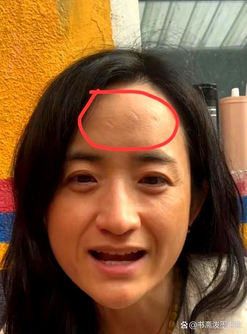 女人額頭有疤真的會命苦嗎 不宜有疤痕的部位是哪里