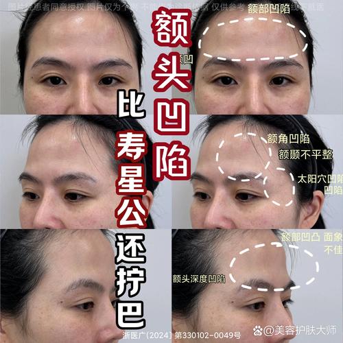 額頭飽滿與不飽滿對比 腦門凹陷面相好嗎