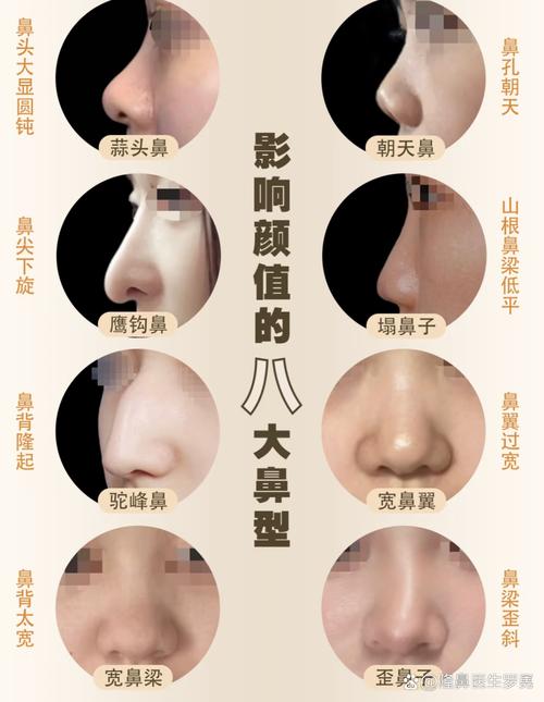 朝天鼻的類型有多少