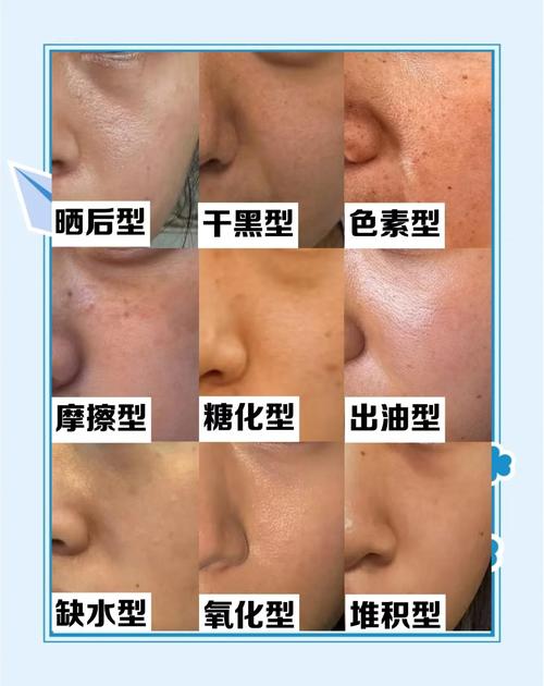 面部皮膚顏色的浮沉、深淺、散摶和澤色夭色