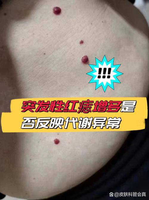 抬頭紋有痣好嗎 是紅痣會如何
