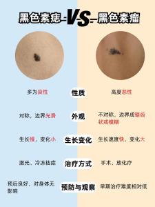 痣和痦子有什么區(qū)別