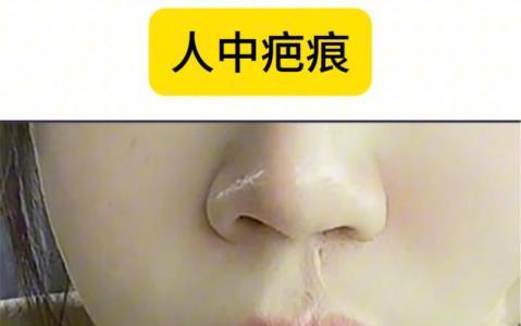 人中疤痕與命運的關系 哪些疤痕會破壞你們的感情