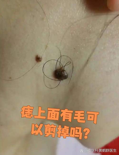痣上長毛是富貴痣嗎