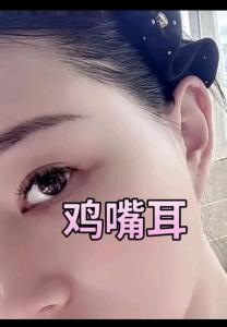 無耳垂和雞嘴耳的區別