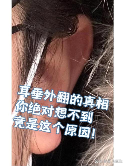 耳廓外翻的人真的命不好嗎 女生耳骨外翻有福
