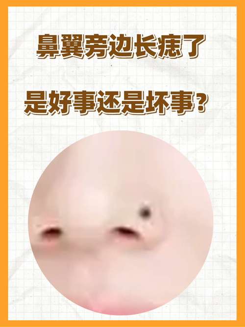 鼻翼兩側長痣 鼻翼兩側有痣好不好