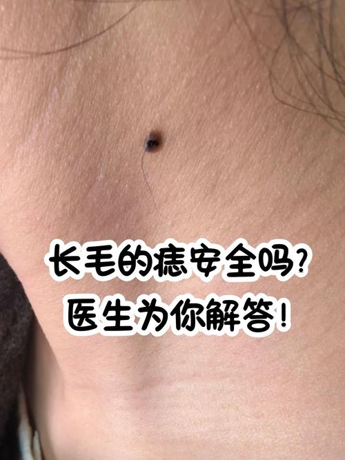 臉上有痣長毛意味著什么 一生衣食無憂煩惱甚少