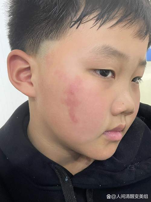 身上有胎記的人好不好 什么顏色的胎記最好