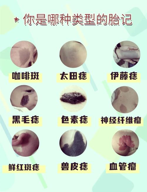 胎記長在身體部位的寓意 有紅胎記的人寓意